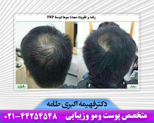 آیا عمل کاشت مو ارزشش را دارد؟